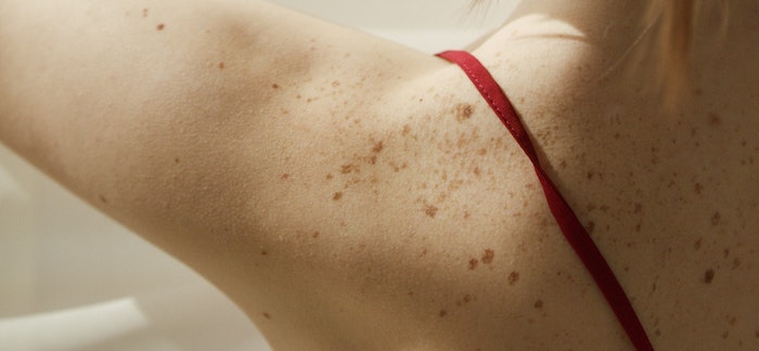 Image of a shoulder with freckles.